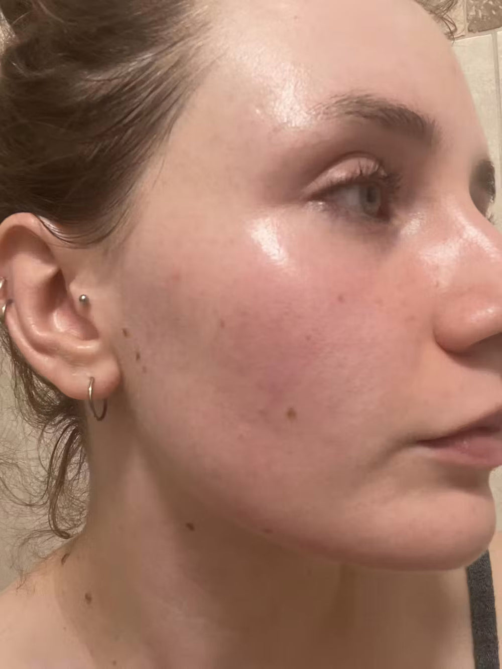 acne SI keep