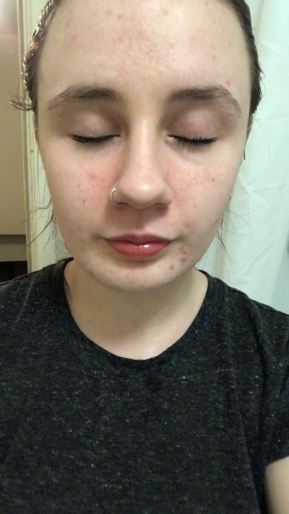 acne SI keep