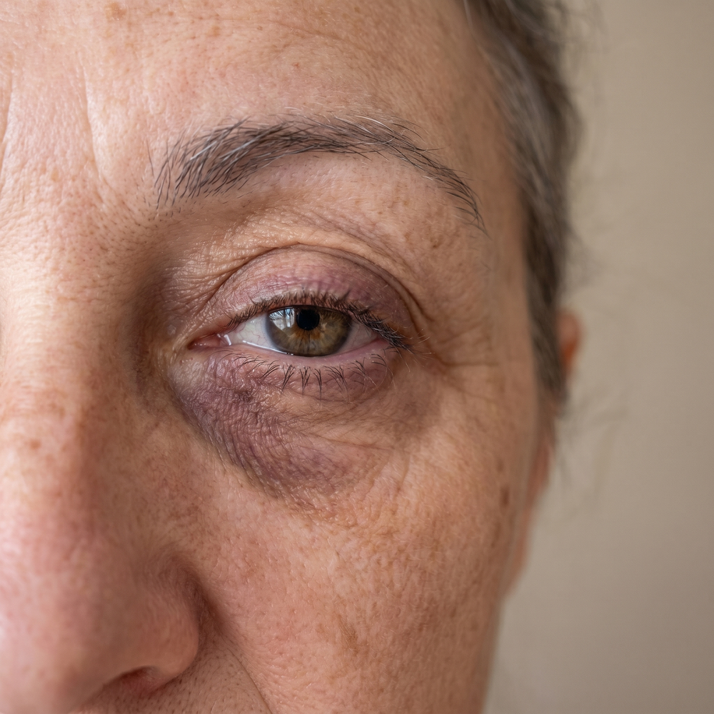 Rose Eye Lift SI