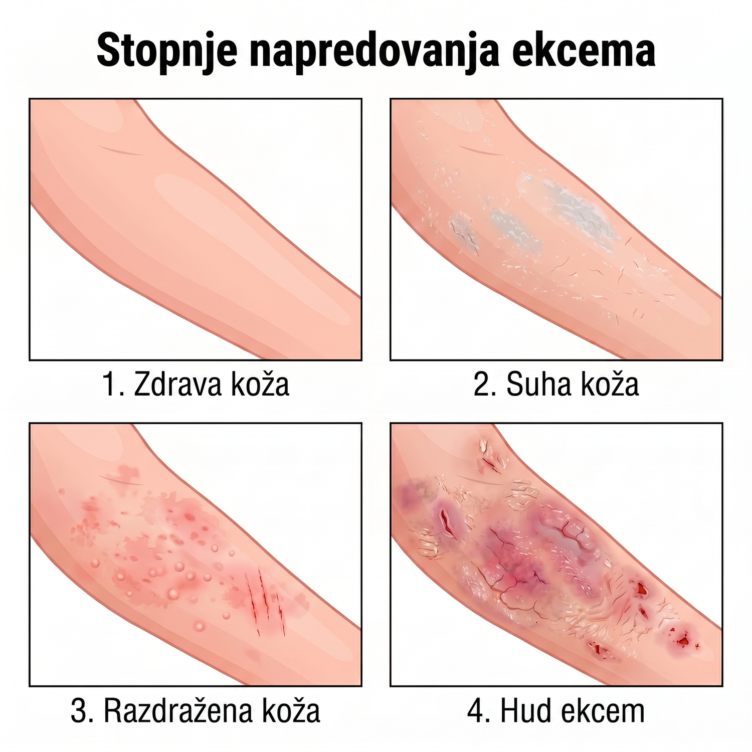eczema_SI_eczema_4stages_v2.png