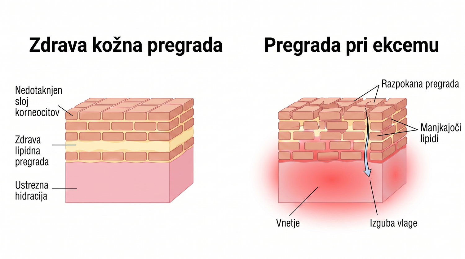 eczema_SI_skin_barrier_v2.png
