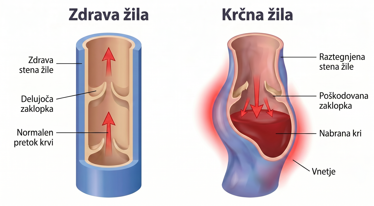 periodontis