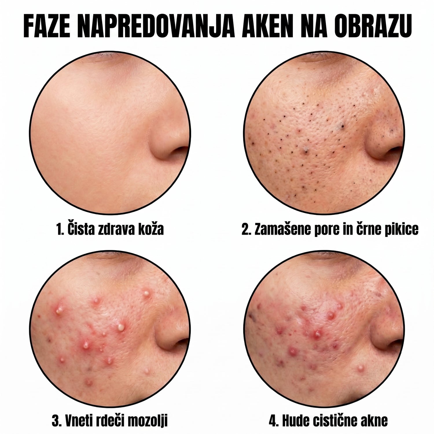 acne SI translated